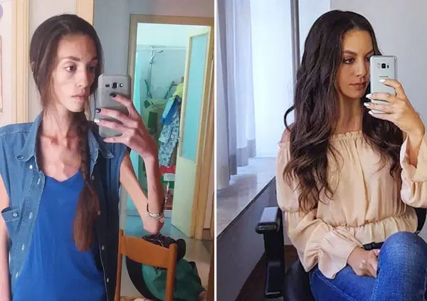 Io, l'anoressia fino a 27 chili, l'amore, la rinascita e un figlio in arrivo. Intervista a Fabiana Negrini