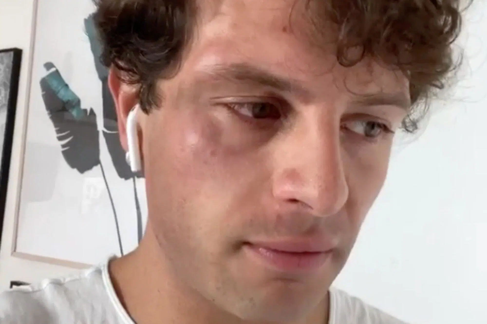 L'influencer Iconize che mostra i lividi di una finta aggressione omofoba per lavoro